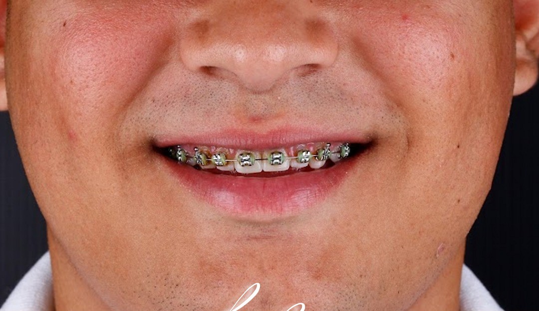 Before treatment